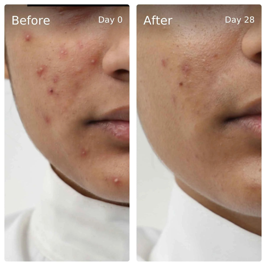 Clinical trial before and after, day 0 vs day 28
