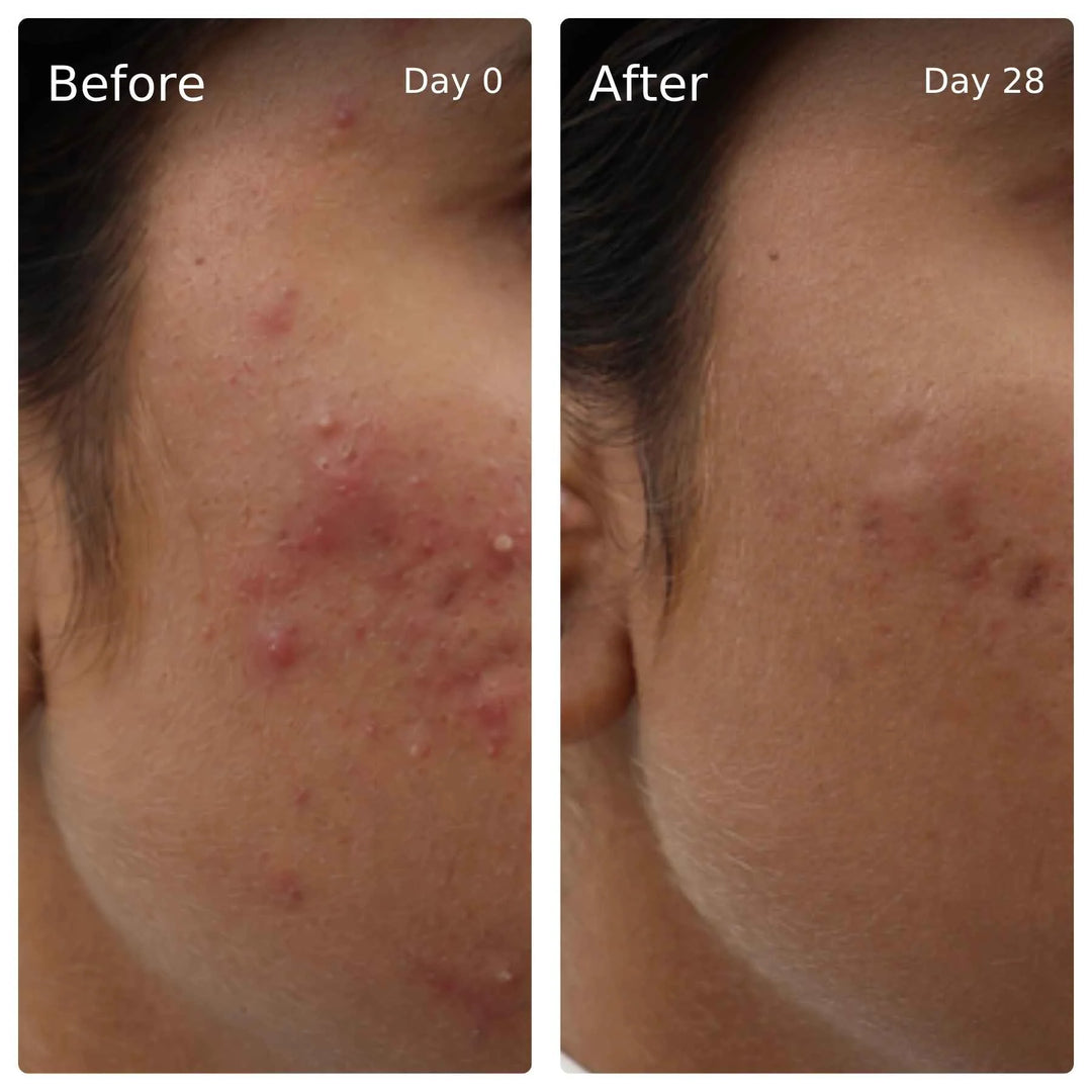 Clinical trial before and after, day 0 vs day 28