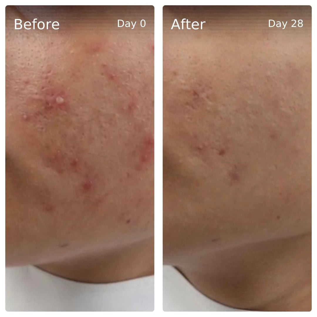 Clinical trial before and after, day 0 vs day 28