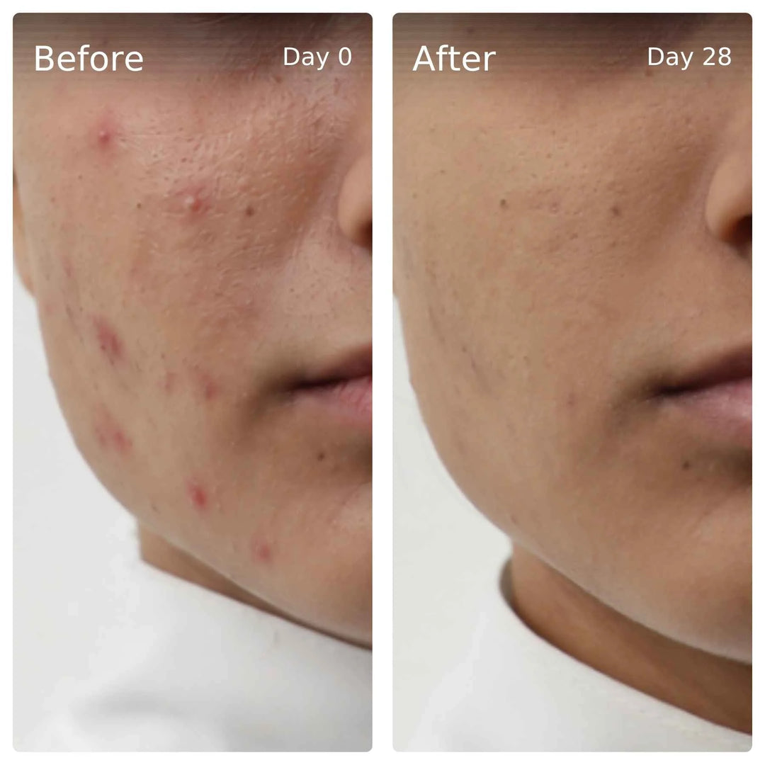 Clinical trial before and after, day 0 vs day 28