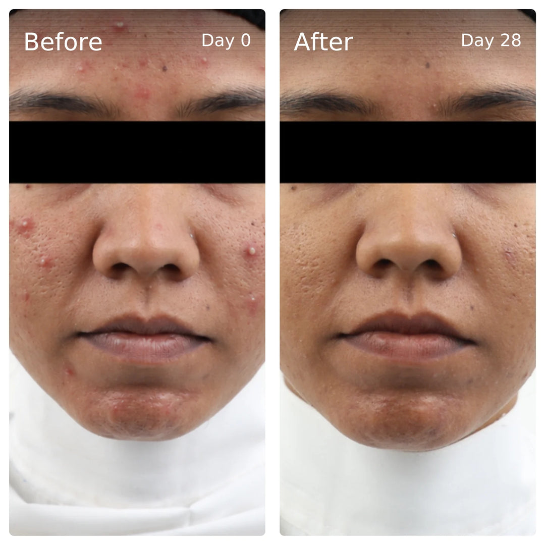 Clinical trial before and after, day 0 vs day 28