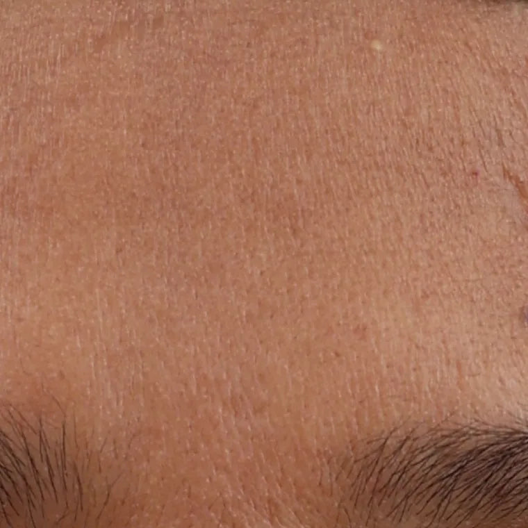 Every patient saw spots fade
