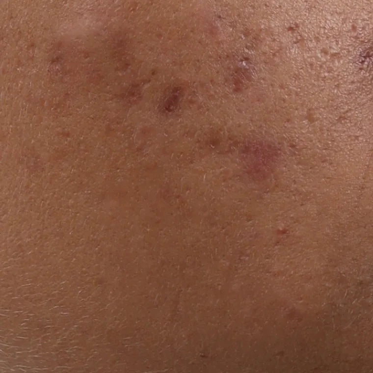 Fewer breakouts