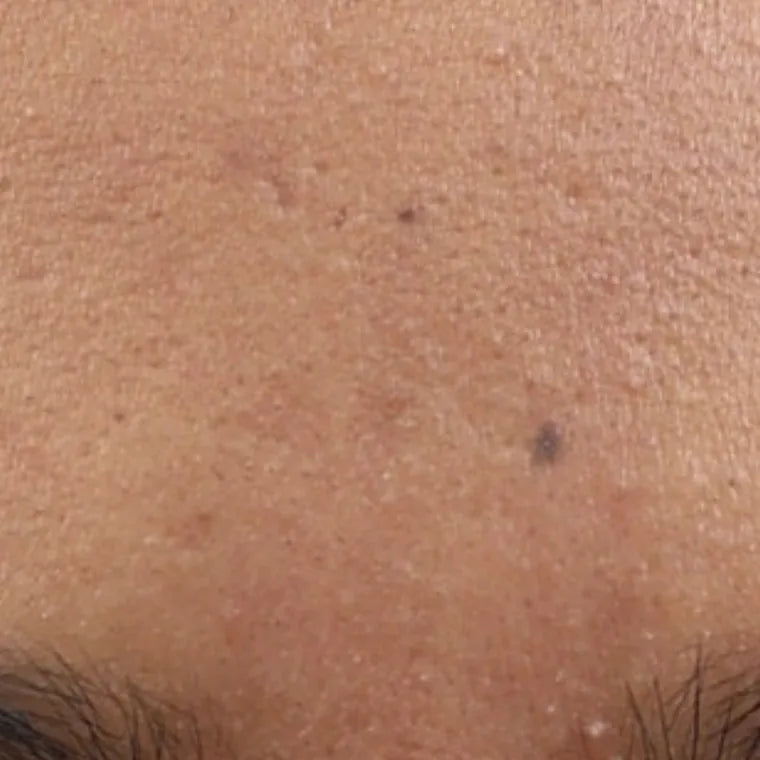 Unclogs the pore