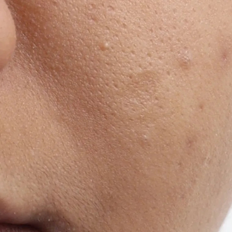 Controls sebum